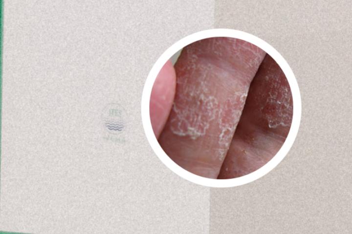 银屑病导致指甲变形，该如何治疗