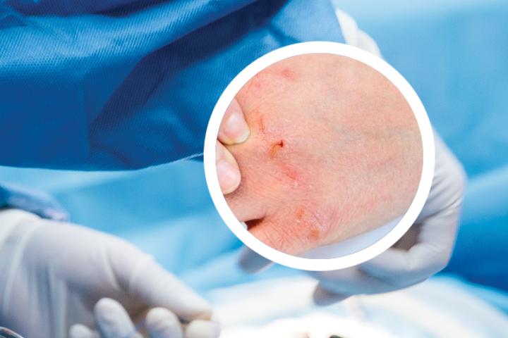 指甲型银屑病可以治愈吗